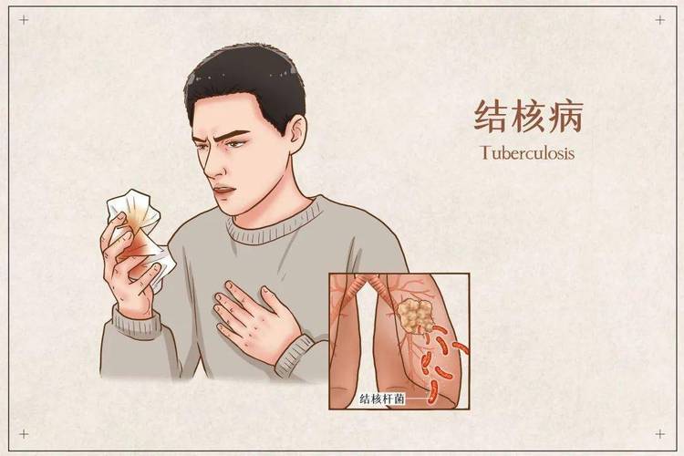 结核病督导简报范文