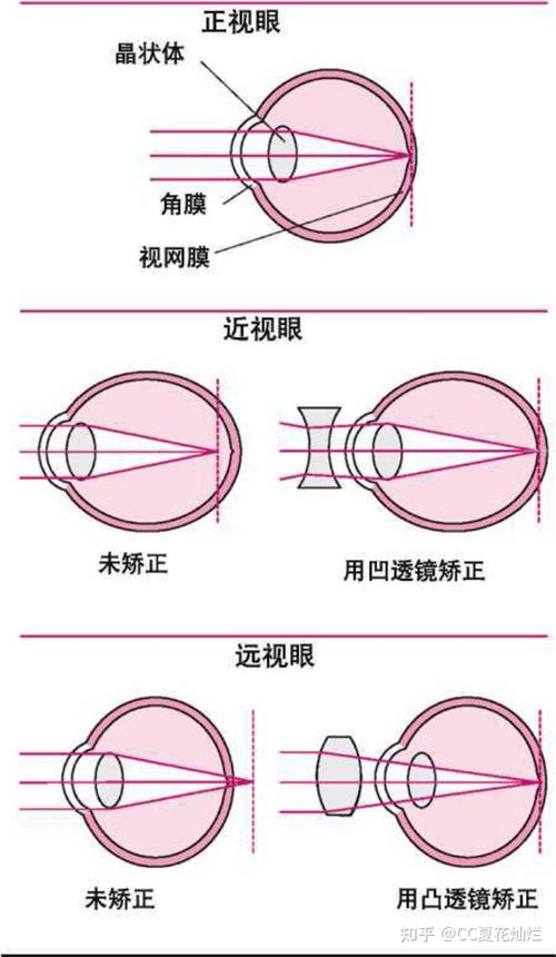 近视眼防控工作方案