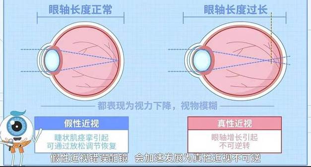 近视的调研报告